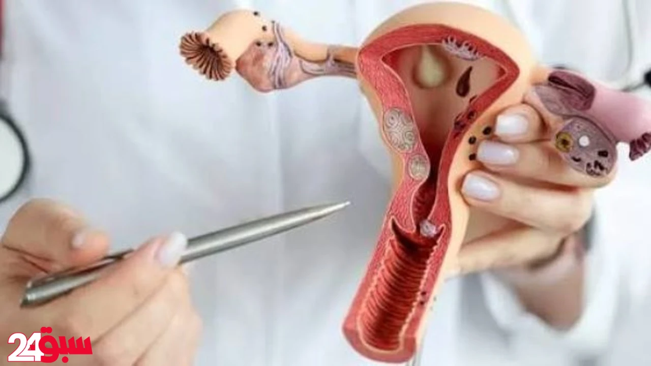 تكيس المبايض ونزوله مع الدورة.. علامات تكشف حقيقة شكله وكيف تلاحظينه